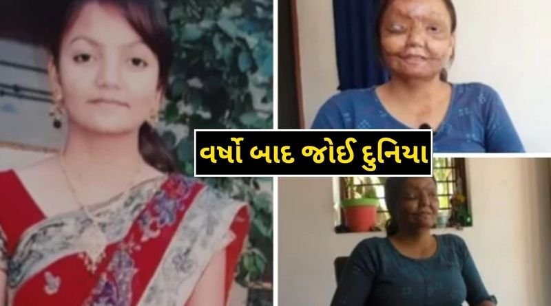 The girl who was a victim of acid attack in Mehsana saw the world after years